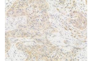 ABIN6256096 and ABIN6267277 at 1/100 staining human tongue carcinoma by IHC-P.