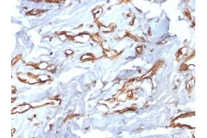 Formalin-fixed, paraffin-embedded human Angiosarcoma stained with CD34 Recombinant Rabbit Monoclonal Antibody (HPCA1/2598R). (Recombinant CD34 抗体)