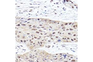Immunohistochemistry of paraffin-embedded human esophageal cancer using PSMB2 Rabbit pAb (ABIN6129442, ABIN6146314, ABIN6146316 and ABIN6221150) at dilution of 1:100 (40x lens). (PSMB2 抗体  (AA 1-201))