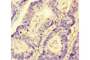 Immunohistochemistry of paraffin-embedded human colon cancer using ABIN7161435 at dilution of 1:100 (NRP2 抗体  (AA 60-209))