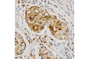 Immunohistochemistry of paraffin-embedded human stomach cancer using OLR1 antibody at dilution of 1:200 (x400 lens). (OLR1 抗体  (AA 58-273))