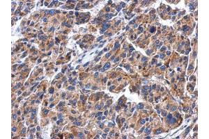 IHC-P Image Immunohistochemical analysis of paraffin-embedded human hepatoma, using GBA, antibody at 1:500 dilution. (GBA 抗体  (Center))