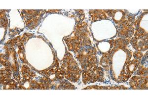 Immunohistochemistry of paraffin-embedded Human thyroid cancer tissue using SLC12A4 Polyclonal Antibody at dilution 1:30 (SLC12A4 抗体)