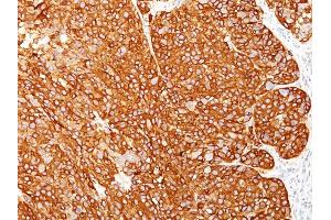 Formalin-fixed, paraffin-embedded human Melanoma stained with Melanoma Marker Monoclonal Antibody (M2-7C10 + M2-9E3 + T311 + HMB45). (Melanoma Marker (MART-1 + Tyrosinase + Gp100) 抗体)