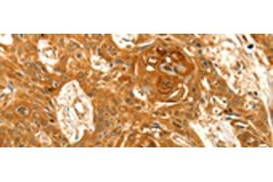 Immunohistochemistry of paraffin-embedded Human esophagus cancer tissue using VSNL1 Polyclonal Antibody at dilution of 1:25(x200) (VSNL1 抗体)