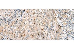 Immunohistochemistry of paraffin-embedded Human cervical cancer tissue using GTF3C2 Polyclonal Antibody at dilution of 1:45(x200) (GTF3C2 抗体)