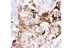 Anti- HMOX2 antibody, IHC(P) IHC(P): Human Lung Cancer Tissue (HMOX2 抗体  (AA 2-316))