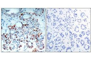 Immunohistochemical analysis of paraffin-embedded human breast carcinoma tissue using BIM(Phospho-Ser69) Antibody(left) or the same antibody preincubated with blocking peptide(right). (BIM 抗体  (pSer69))