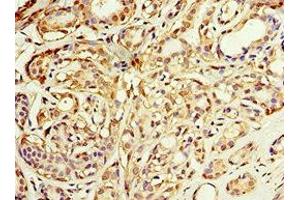 Immunohistochemistry of paraffin-embedded human breast cancer using ABIN7143649 at dilution of 1:100 (ADH1C 抗体  (AA 1-375))