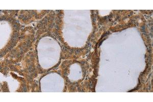 Immunohistochemistry of paraffin-embedded Human thyroid cancer using RNF5 Polyclonal Antibody at dilution of 1:35 (RNF5 抗体)
