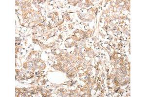 Immunohistochemical analysis of paraffin-embedded Human breast cancer tissue using at dilution 1/30. (CDH23 抗体  (C-Term))