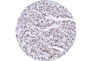 Strong nuclear TFE3 positivity in a renal cell carcinoma with TFE3 fusion (Recombinant TFE3 抗体)