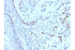Formalin-fixed, paraffin-embedded human Colon Carcinoma stained with Cyclin E Mouse Monoclonal Antibody (CCNE1/2460). (Cyclin E1 抗体  (AA 10-176))