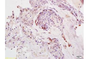 Formalin-fixed and paraffin embedded human colon carcinoma labeled with Anti-SDHD Polyclonal Antibody, Unconjugated (ABIN751918) at 1:200, followed by conjugation to the secondary antibody and DAB staining (SDHD 抗体  (AA 81-159))