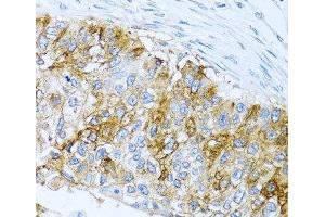 Immunohistochemistry of paraffin-embedded Human lung cancer using IFIT3 Polyclonal Antibody at dilution of 1:100 (40x lens). (IFIT3 抗体)