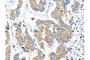 ABIN7094677 and ABIN7098728 at 1/100 staining Human breast cancer by IHC-P. (KCNK9 抗体  (N-Term))