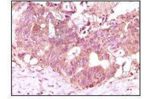 Immunohistochemical analysis of paraffin-embedded human recturn adenocarcinoma tissue showing cytoplasmic localization using FGF2 mouse mAb with DAB staining. (FGF2 抗体)