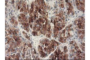 Immunohistochemical staining of paraffin-embedded Carcinoma of Human liver tissue using anti-CYP2C9 mouse monoclonal antibody. (CYP2C9 抗体)