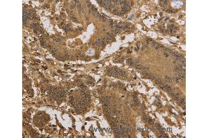 Immunohistochemistry of Human colon cancer using KDM5B Polyclonal Antibody at dilution of 1:40