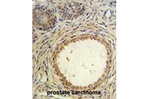 AMH Antibody (Center) IHC analysis in formalin fixed and paraffin embedded prostate carcinoma followed by peroxidase conjugation of the secondary antibody and DAB staining. (AMH 抗体  (Middle Region))
