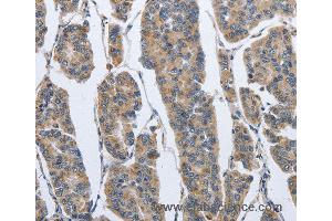 Immunohistochemistry of Human breast cancer using IPO7 Polyclonal Antibody at dilution of 1:40 (IPO7 抗体)