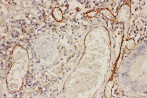 Anti-ICAM1 Picoband antibody,  IHC(P): Human Intestinal Cancer Tissue (ICAM1 抗体  (AA 214-532))