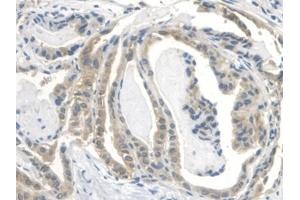 Detection of IGFBP2 in Human Thyroid cancer Tissue using Polyclonal Antibody to Insulin Like Growth Factor Binding Protein 2 (IGFBP2) (IGFBP2 抗体  (AA 148-325))