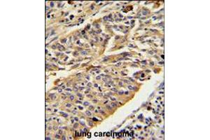 CTSE Antibody IHC analysis in formalin fixed and paraffin embedded human lung carcinoma followed by peroxidase conjugation of the secondary antibody and DAB staining. (Cathepsin E 抗体  (AA 157-187))