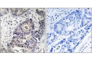 Immunohistochemistry analysis of paraffin-embedded human colon carcinoma, using iNOS (Phospho-Tyr151) Antibody. (NOS2 抗体  (pTyr151))