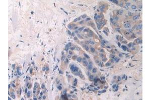 Detection of FBLN1 in Human Breast cancer Tissue using Polyclonal Antibody to Fibulin 1 (FBLN1) (Fibulin 1 抗体  (AA 176-398))