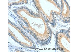 Immunohistochemistry of Human colon cancer using ASGR1 Polyclonal Antibody at dilution of 1:50 (Asialoglycoprotein Receptor 1 抗体)