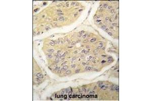 Formalin-fixed and paraffin-embedded human lung carcinoma tissue reacted with B2M antibody (N-term) (ABIN389258 and ABIN2839396) , which was peroxidase-conjugated to the secondary antibody, followed by DAB staining. (beta-2 Microglobulin 抗体  (N-Term))
