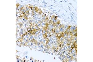 Immunohistochemistry of paraffin-embedded human lung cancer using IFIT3 antibody (ABIN1680389, ABIN3018293, ABIN3018295 and ABIN6220427) at dilution of 1:100 (40x lens). (IFIT3 抗体  (AA 128-331))