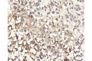 Immunohistochemistry analysis of paraffin-embedded human liver cancer using TEK Polyclonal Antibody at dilution of 1:200. (TEK 抗体)