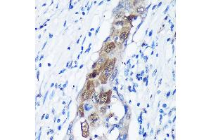 Immunohistochemistry of paraffin-embedded Human lung cancer using C Rabbit pAb (ABIN7266022) at dilution of 1:100 (40x lens). (CAMKK1 抗体  (AA 399-520))