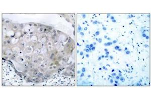 Immunohistochemical analysis of paraffin- embedded human breast carcinoma tissue using V (VEGFR2/CD309 抗体  (pTyr951))