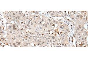 Immunohistochemistry of paraffin-embedded Human esophagus cancer tissue using ARHGDIB Polyclonal Antibody at dilution of 1:35(x200) (ARHGDIB 抗体)