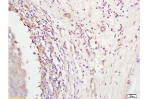 Formalin-fixed and paraffin embedded human breast carcinoma labeled with Rabbit Anti-Follistatin Polyclonal Antibody (ABIN734258) at 1:200 followed by conjugation to the secondary antibody and DAB staining. (Follistatin 抗体  (AA 151-250))
