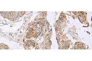 Immunohistochemistry of paraffin-embedded Human colorectal cancer tissue using RTKN2 Polyclonal Antibody at dilution of 1:75(x200)