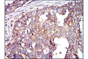 Immunohistochemical analysis of paraffin-embedded breast cancer tissues using G6PD mouse mAb with DAB staining. (Glucose-6-Phosphate Dehydrogenase 抗体)