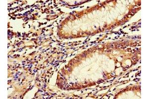 Immunohistochemistry of paraffin-embedded human colon cancer using ABIN7158054 at dilution of 1:100 (LRRIQ3 抗体  (AA 538-607))