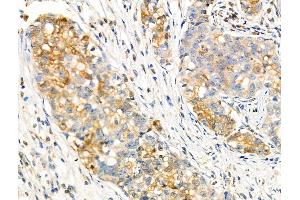 Phospho-FGFR2 (Tyr586/Tyr588) Antibody at 1/100 staining Human gastric cancer by IHC-P.