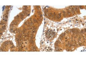 Immunohistochemistry of paraffin-embedded Human colon cancer tissue using SPDEF Polyclonal Antibody at dilution 1:60 (SPDEF/PSE 抗体)
