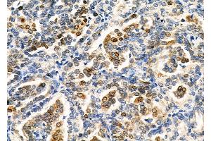 ABIN6265731 and ABIN6266699 at 1/100 staining Human kidney cancer by IHC-P. (TRIM24 抗体  (C-Term))