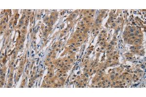 Immunohistochemistry of paraffin-embedded Human gastic cancer using RAGE Polyclonal Antibody at dilution of 1:70 (RAGE 抗体)