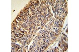 PITX1 antibody IHC analysis in formalin fixed and paraffin embedded human lung carcinoma. (PITX1 抗体  (AA 123-150))