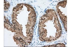 Immunohistochemical staining of paraffin-embedded Adenocarcinoma of Human colon tissue using anti-ACAT2 mouse monoclonal antibody. (ACAT2 抗体)