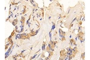 Detection of CK10 in Human Breast cancer Tissue using Polyclonal Antibody to Cytokeratin 10 (CK10) (Keratin 10 抗体  (AA 153-456))