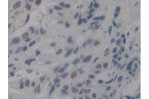 Detection of NCL in Human Mastadenoma Tissue using Polyclonal Antibody to Nucleolin (NCL) (Nucleolin 抗体  (AA 388-569))