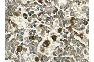 ABIN6257683 and ABIN6274587 at 1/100 staining human melanoma by IHC-P. (Apoptosis Inhibitor 5 抗体  (C-Term))